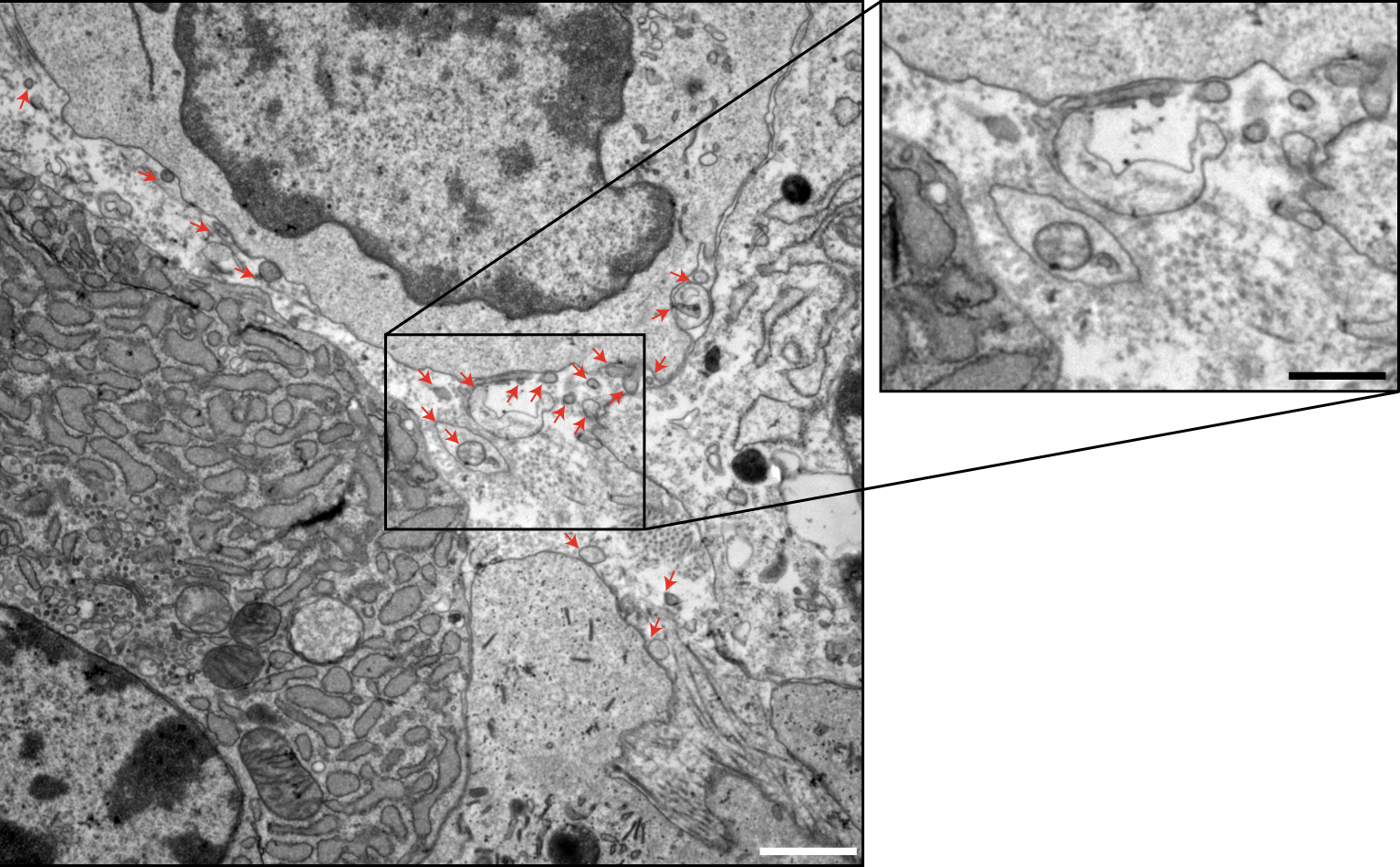 Fig. 1: Representative electron microscopy section of human colon cancer tissue.