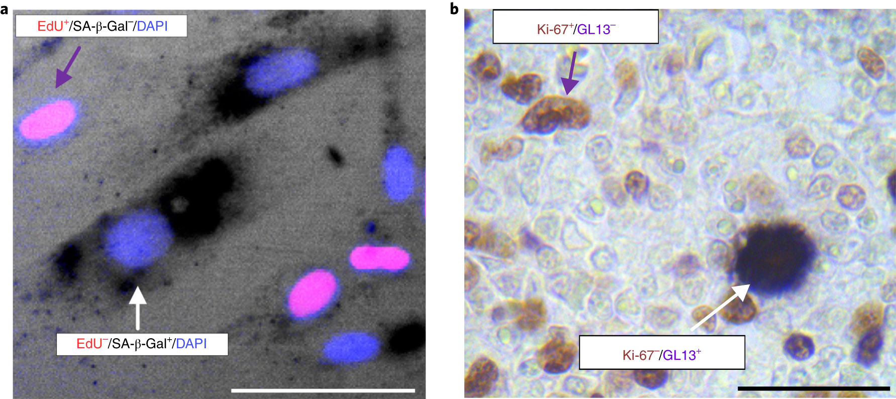 Fig. 3: Double staining SA-β-Gal or LF and proliferation markers.