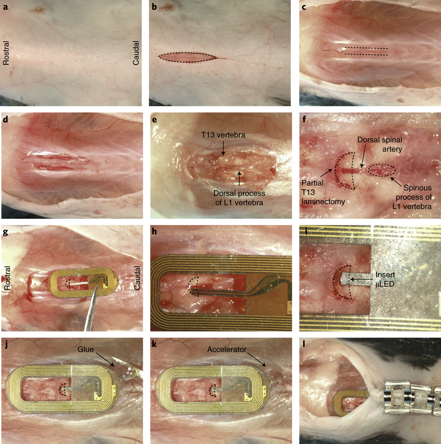Fig. 4: Procedure for implantation of the spinal µLED device.