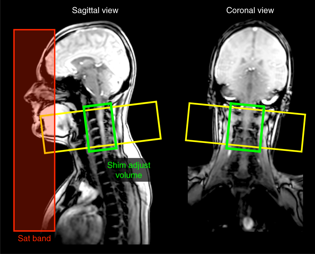 Fig. 8: Positioning of the FOV, shim box and saturation bands for the GRE-ME scan.