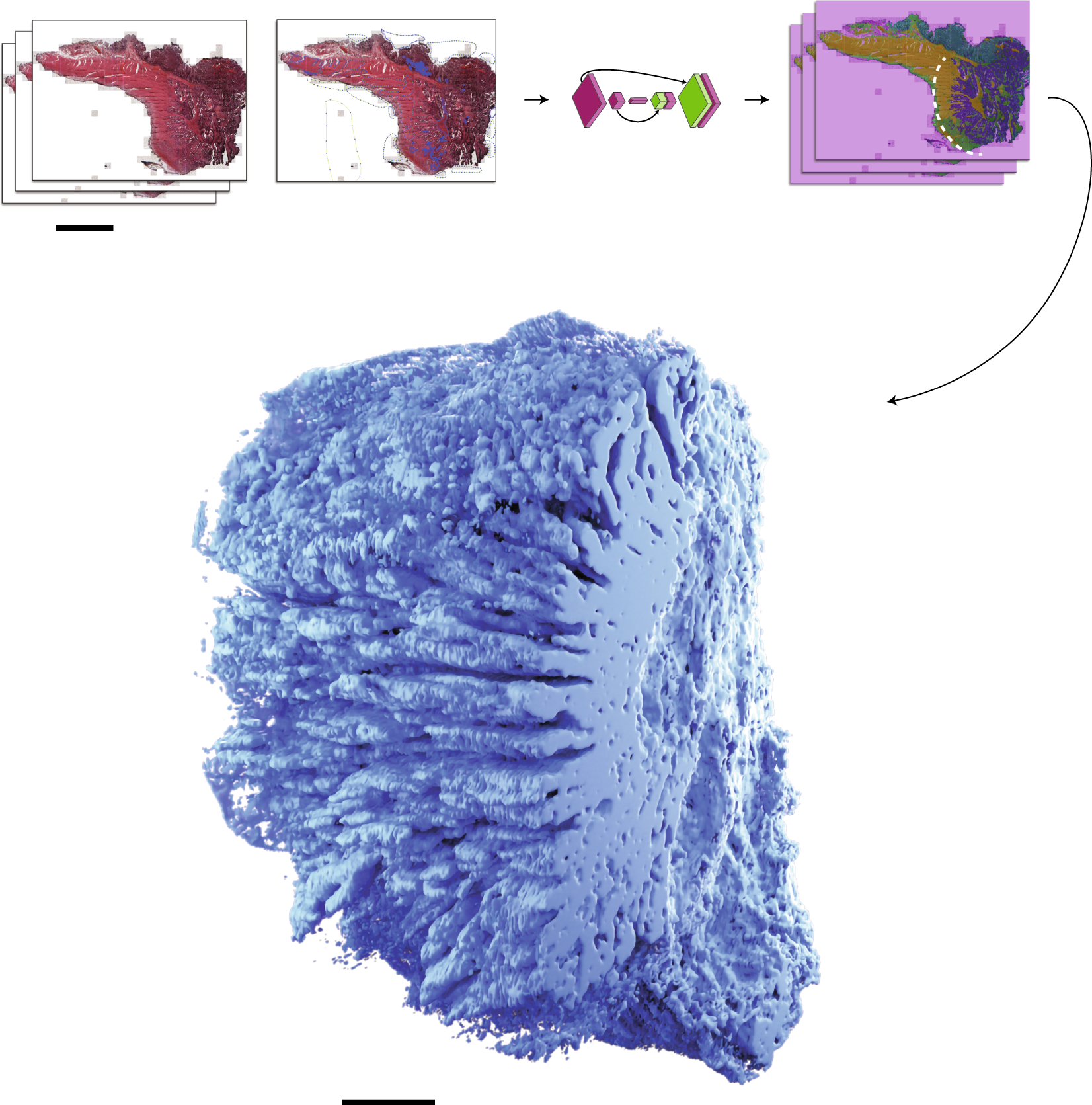 Fig. 3: Three-dimensional colorectal carcinoma.