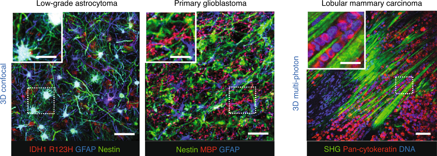 Fig. 5: Identification of glioma cell networks and collective invasion in patient samples.