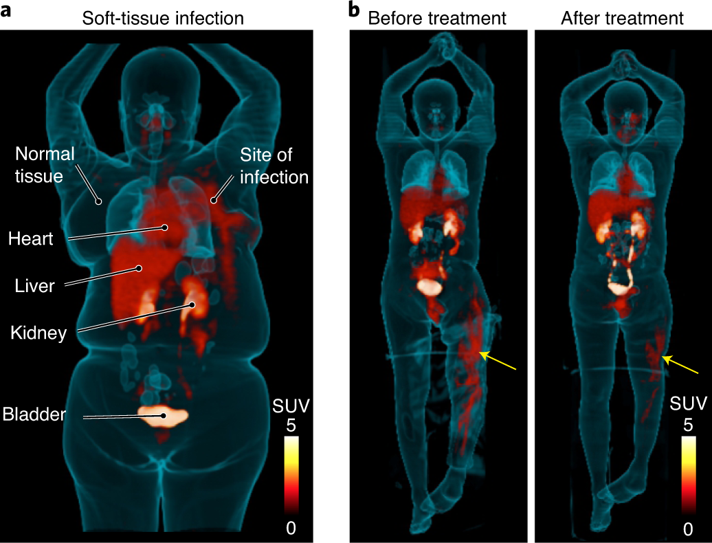 Fig. 1: 18F-FDS PET/CT imaging in patients with confirmed Enterobacterales infections.