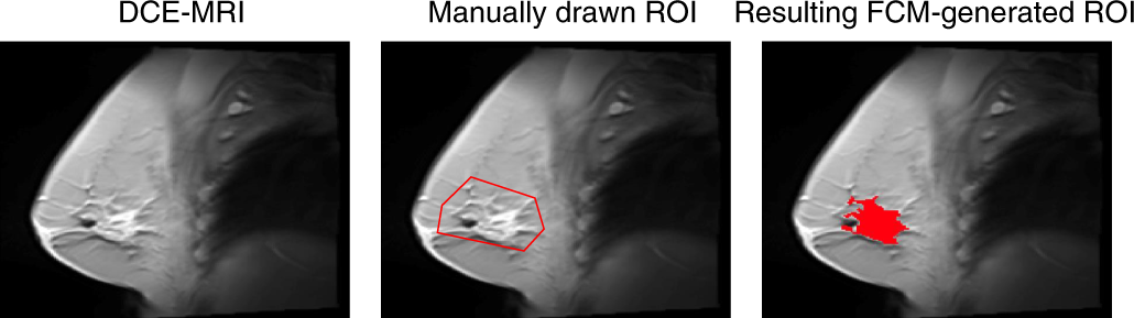 Fig. 3: FCM clustering to generate a tumor ROI.