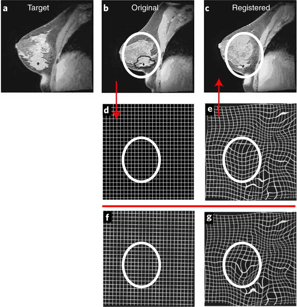 Fig. 4: Comparison of intervisit registration results with and without tumor ROI penalties incorporated into the registration scheme.