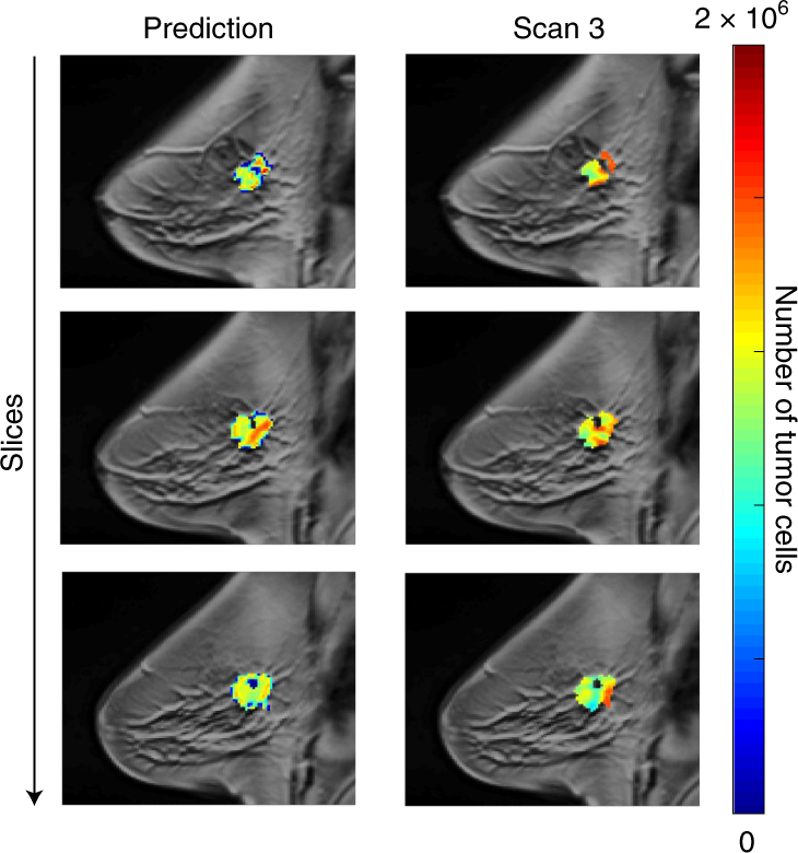 Fig. 9: Results of the 3D model predictions (over three central slices, left column) compared with the observed results at the third scan time (right column) for one example patient.