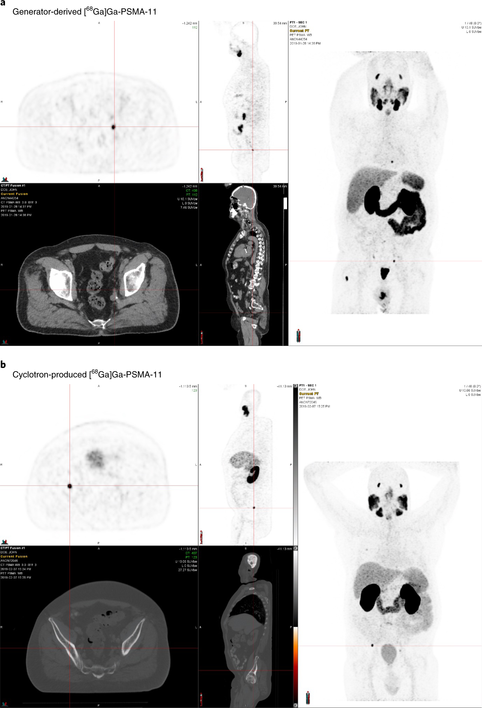 Fig. 9: Prostate cancer PET–CT scans obtained using [68Ga]Ga-PSMA-11.