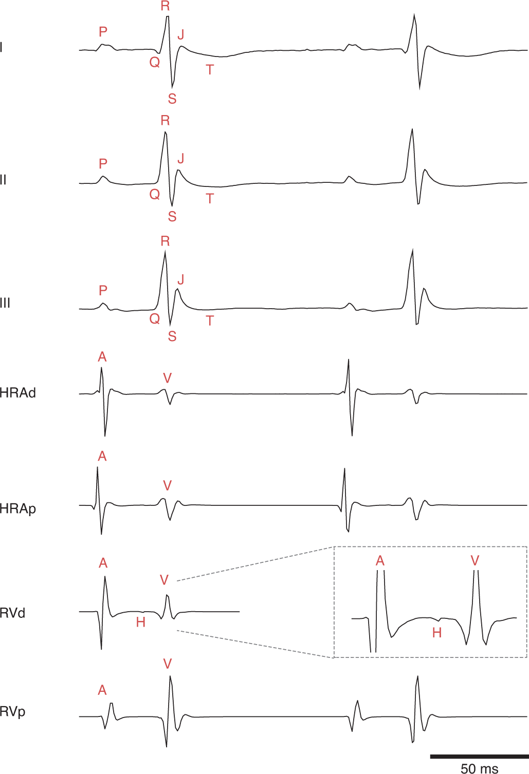 Fig. 3: Baseline surface and intracardiac ECG.