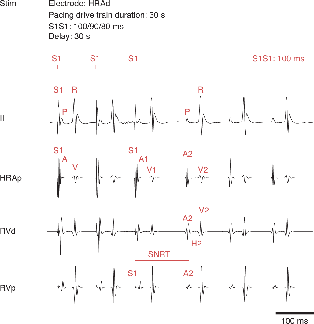 Fig. 8: SNRT.
