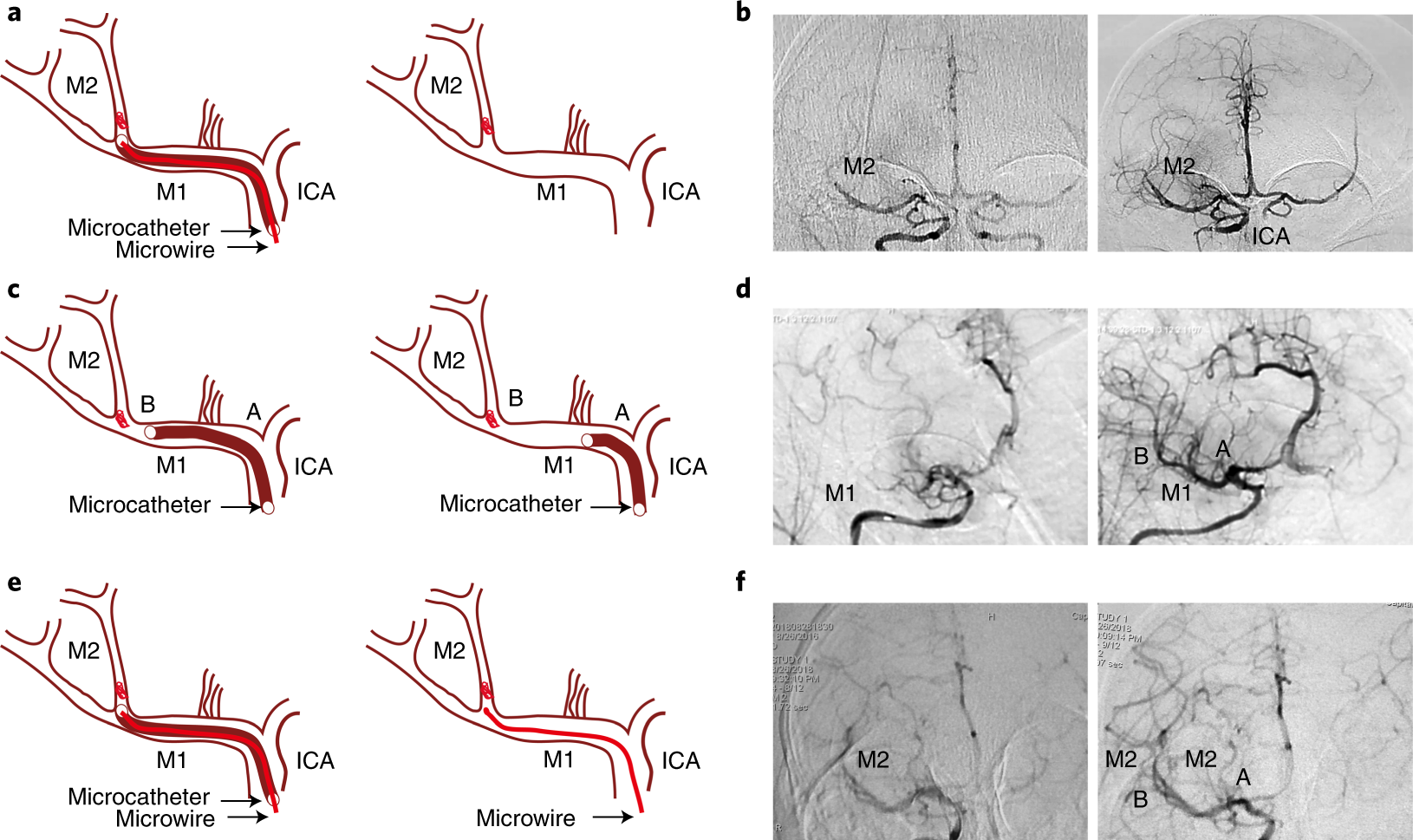 Fig. 4: Graphical images and cerebral arteriogram (anterior projection) revealing permanent occlusion or reperfusion in NHP models.