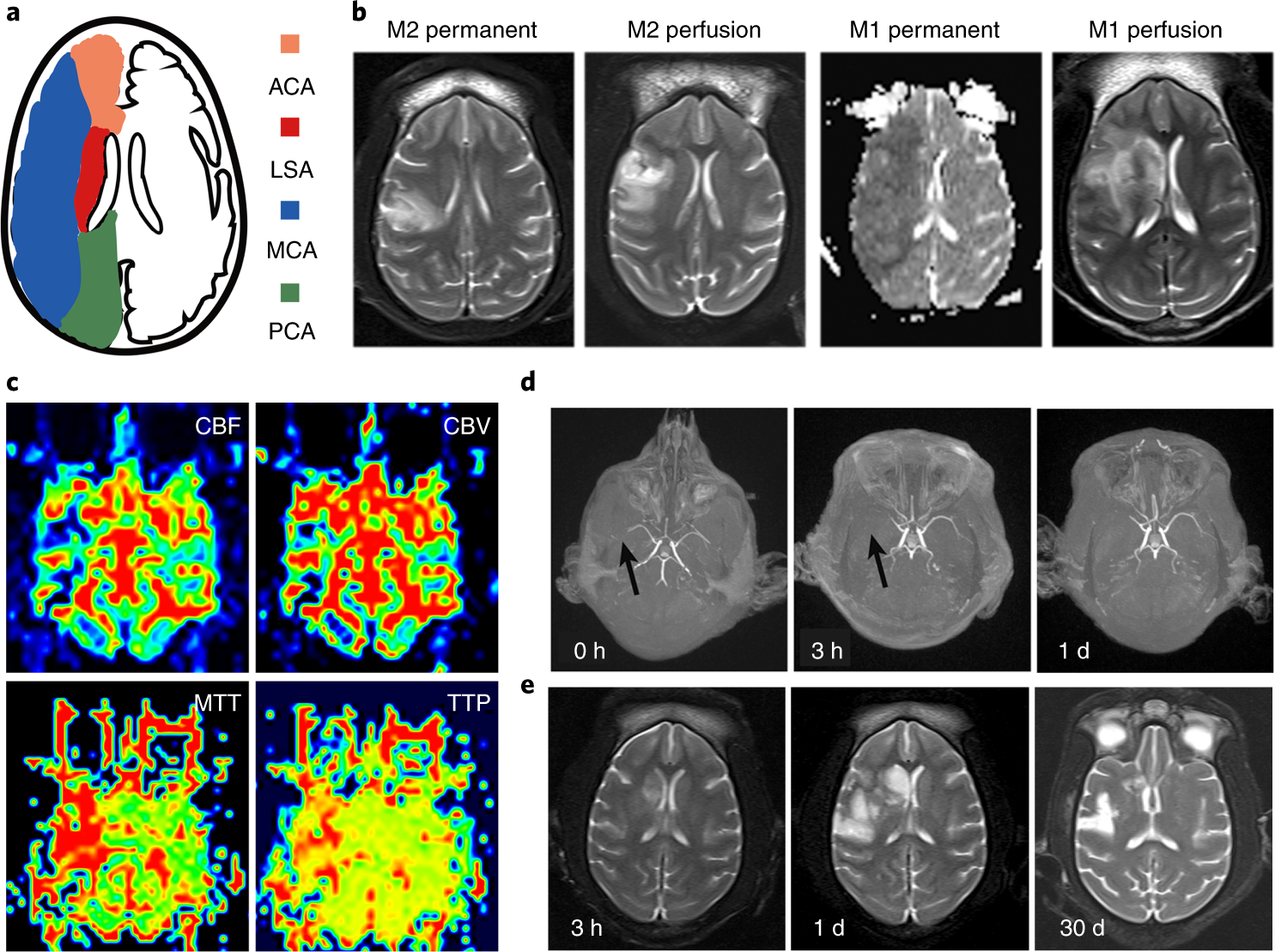 Fig. 6: Infarct sites and sizes in MRI images.