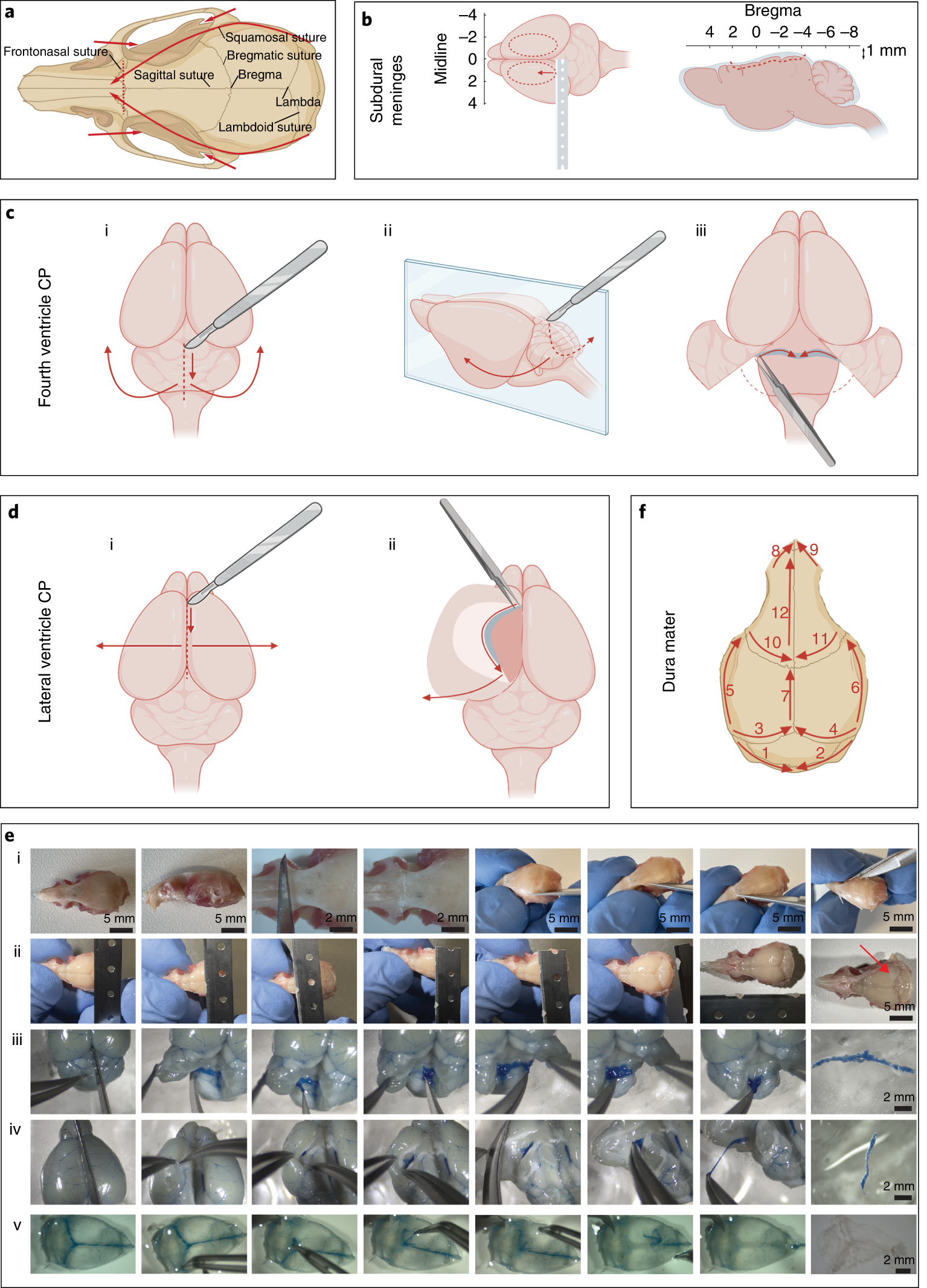 Fig. 2: Dissection of the subdural meninges, CP and dura mater.