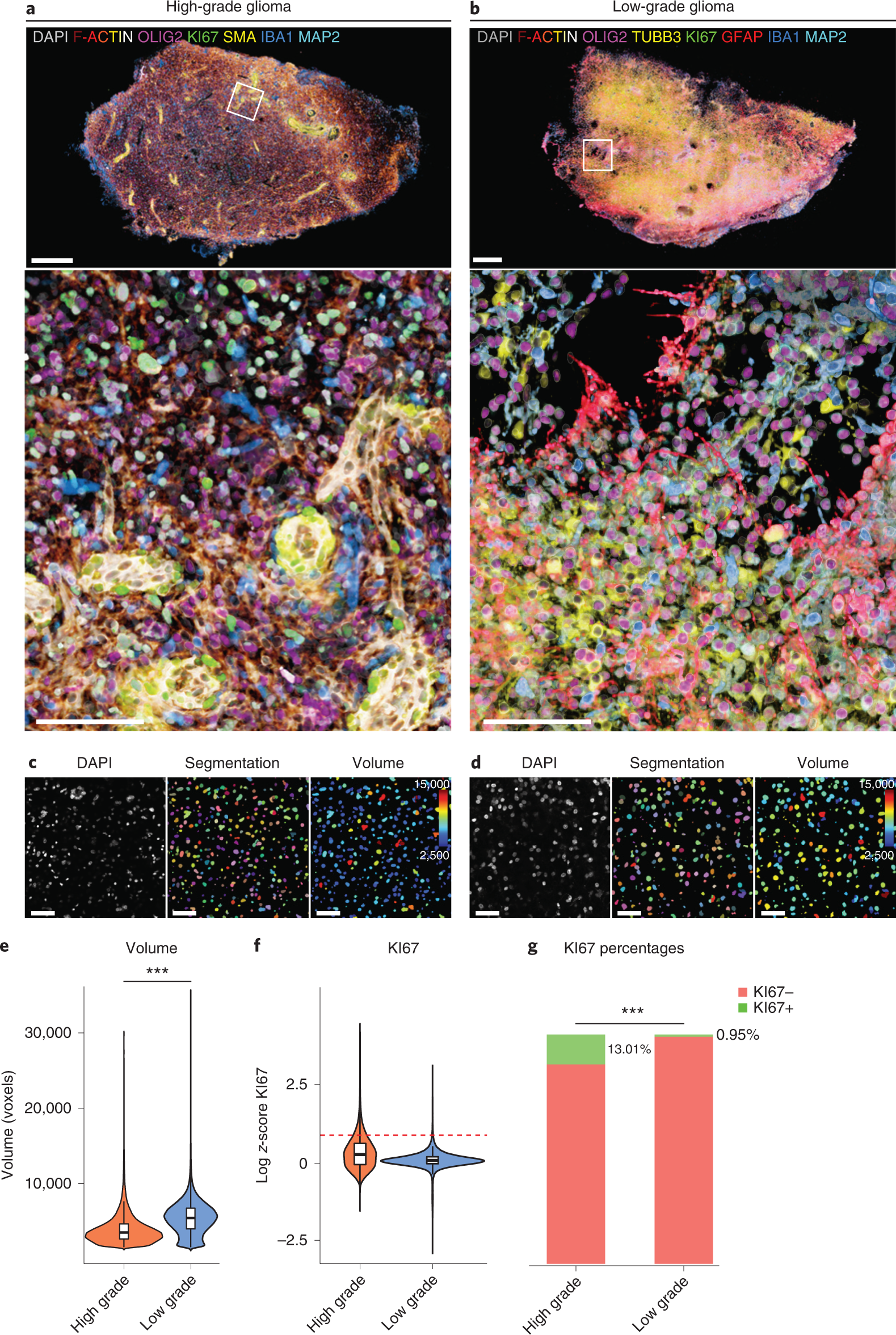 Fig. 6: mLSR-3D guided comparative spatio-phenotypic analysis of human brain tumors.