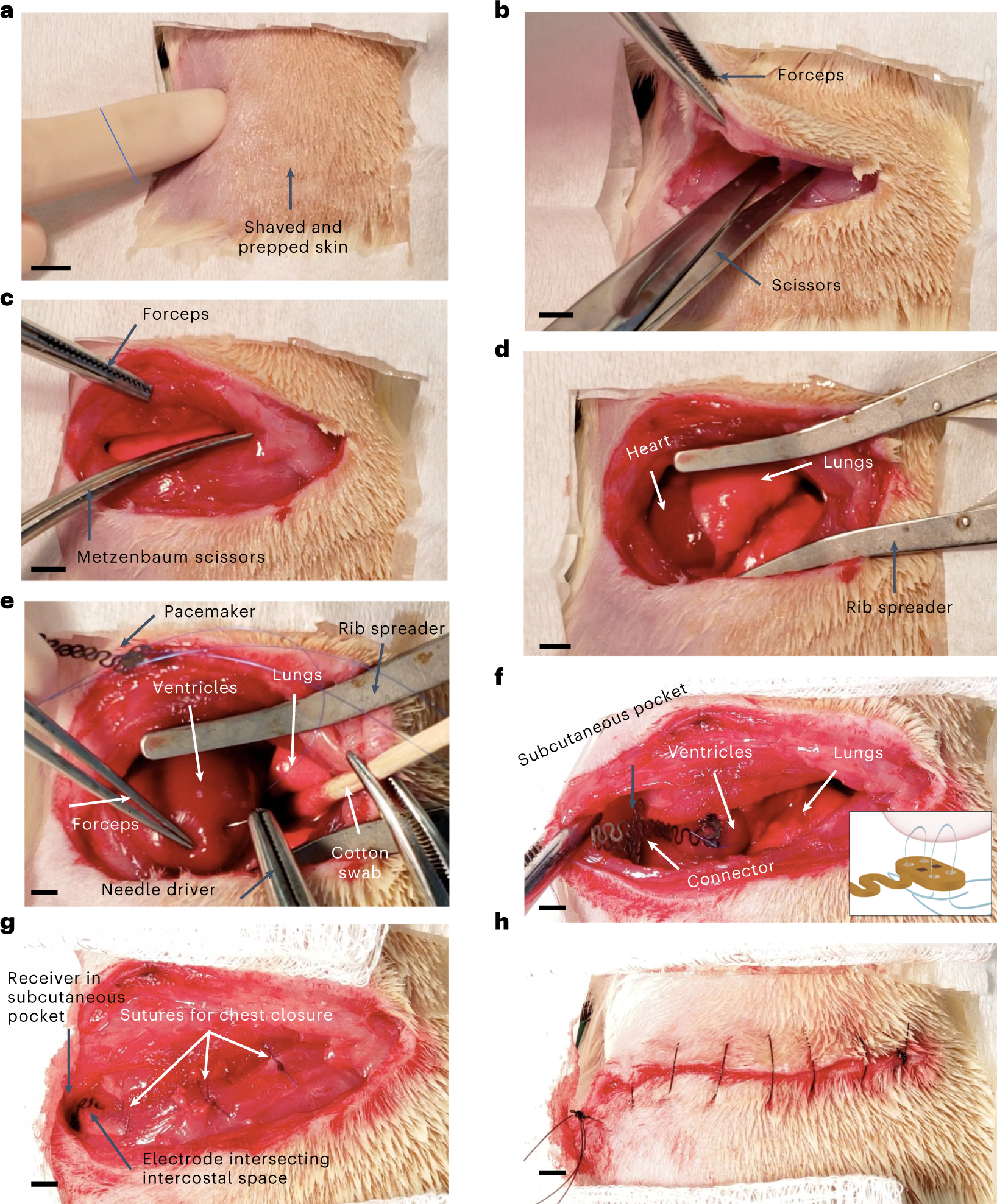 Fig. 4: Pacemaker implantation technique for attachment to ventricles.