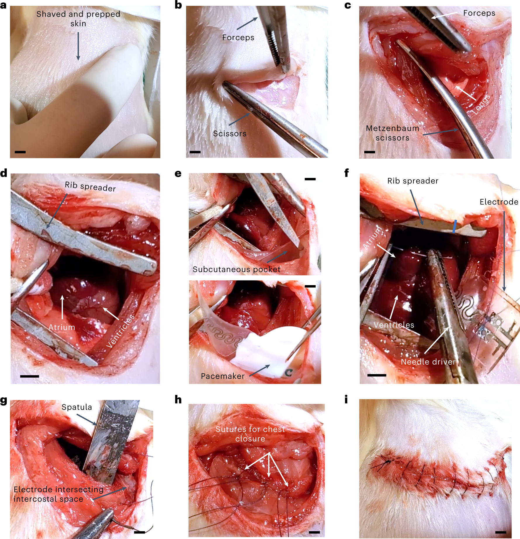 Fig. 5: Pacemaker implantation technique for attachment to right atrium.