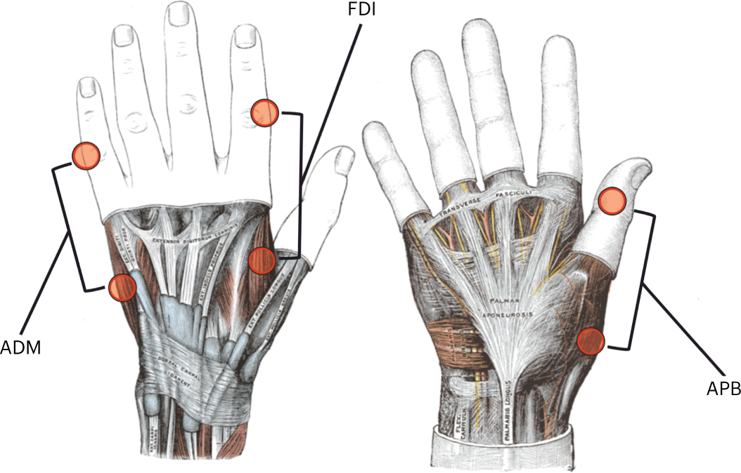Fig. 11: Electrode placement for EMG recordings.