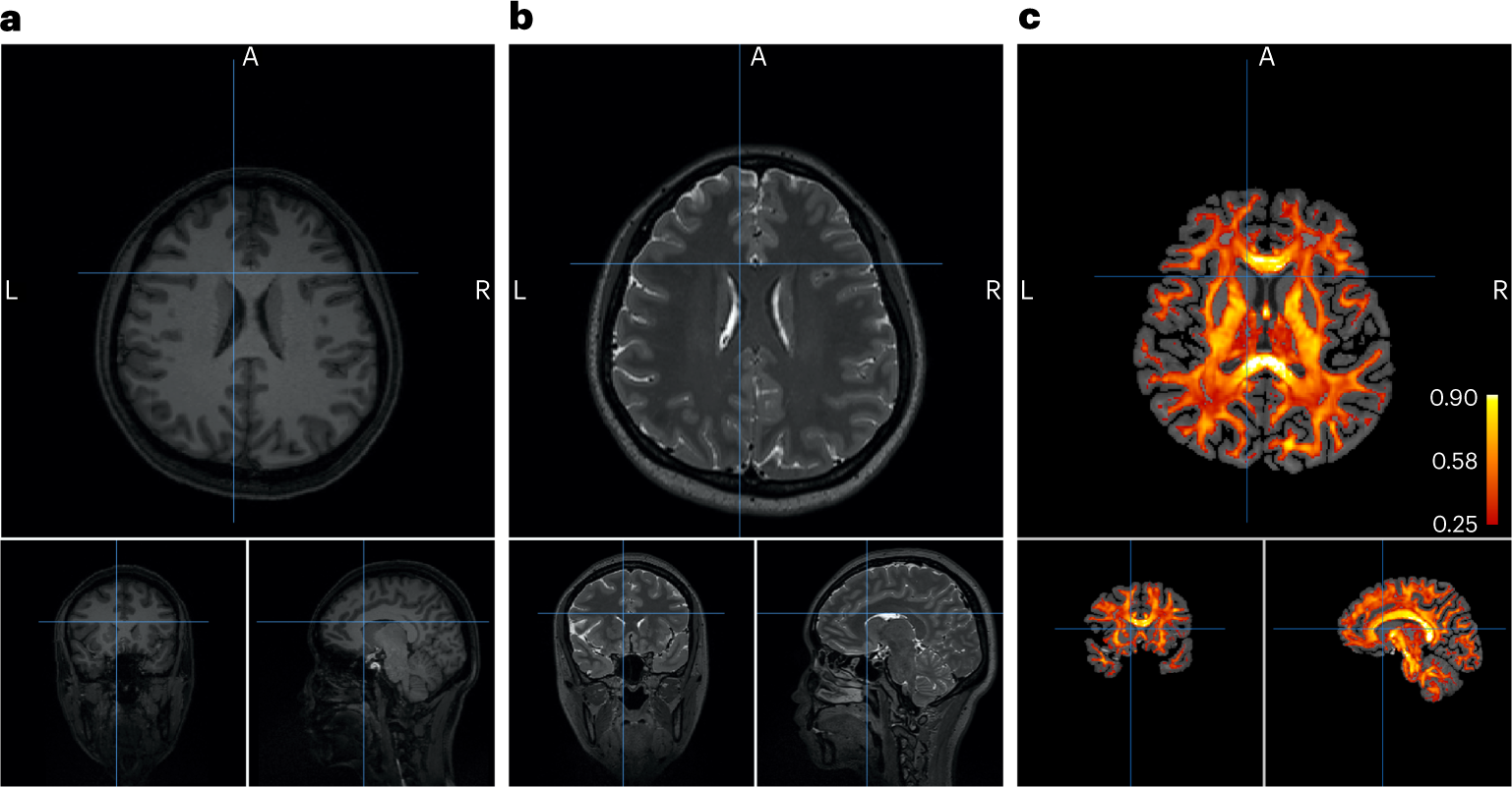 Fig. 2: Example MRI data for subject_0 used for head model construction and field modeling.
