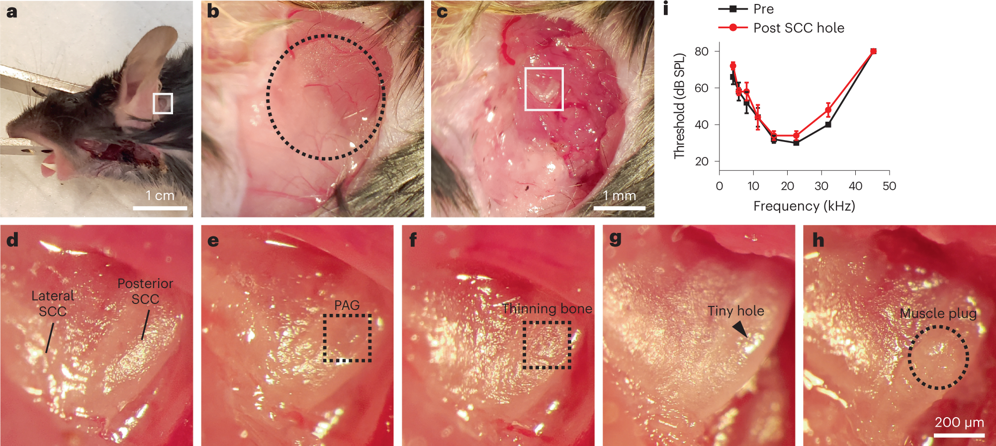 Fig. 5: Intracochlear pressure release through a tiny hole in the semi-circular canal.