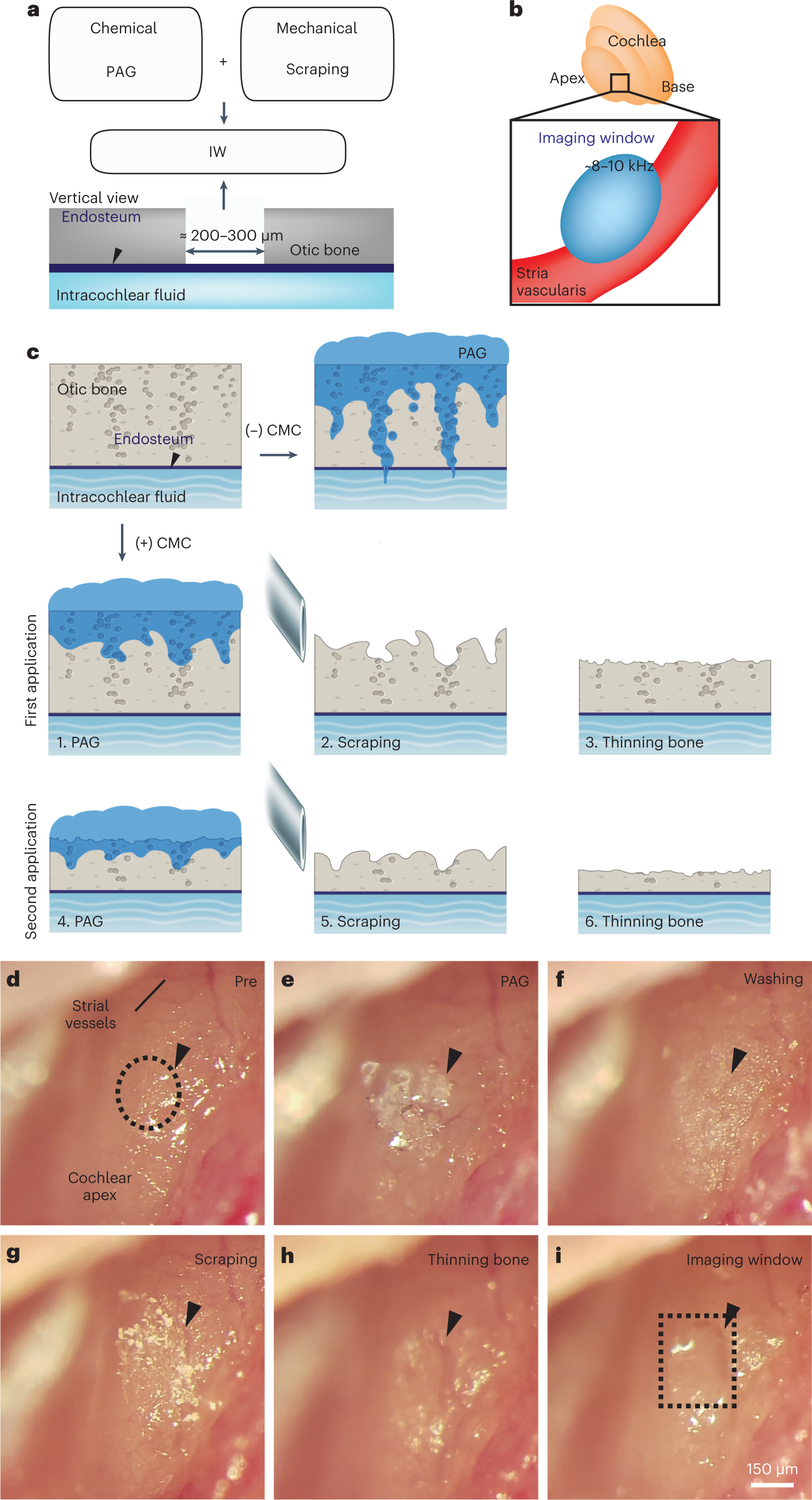 Fig. 6: Surgical approach for creating an imaging window (IW) with preserved hearing function.