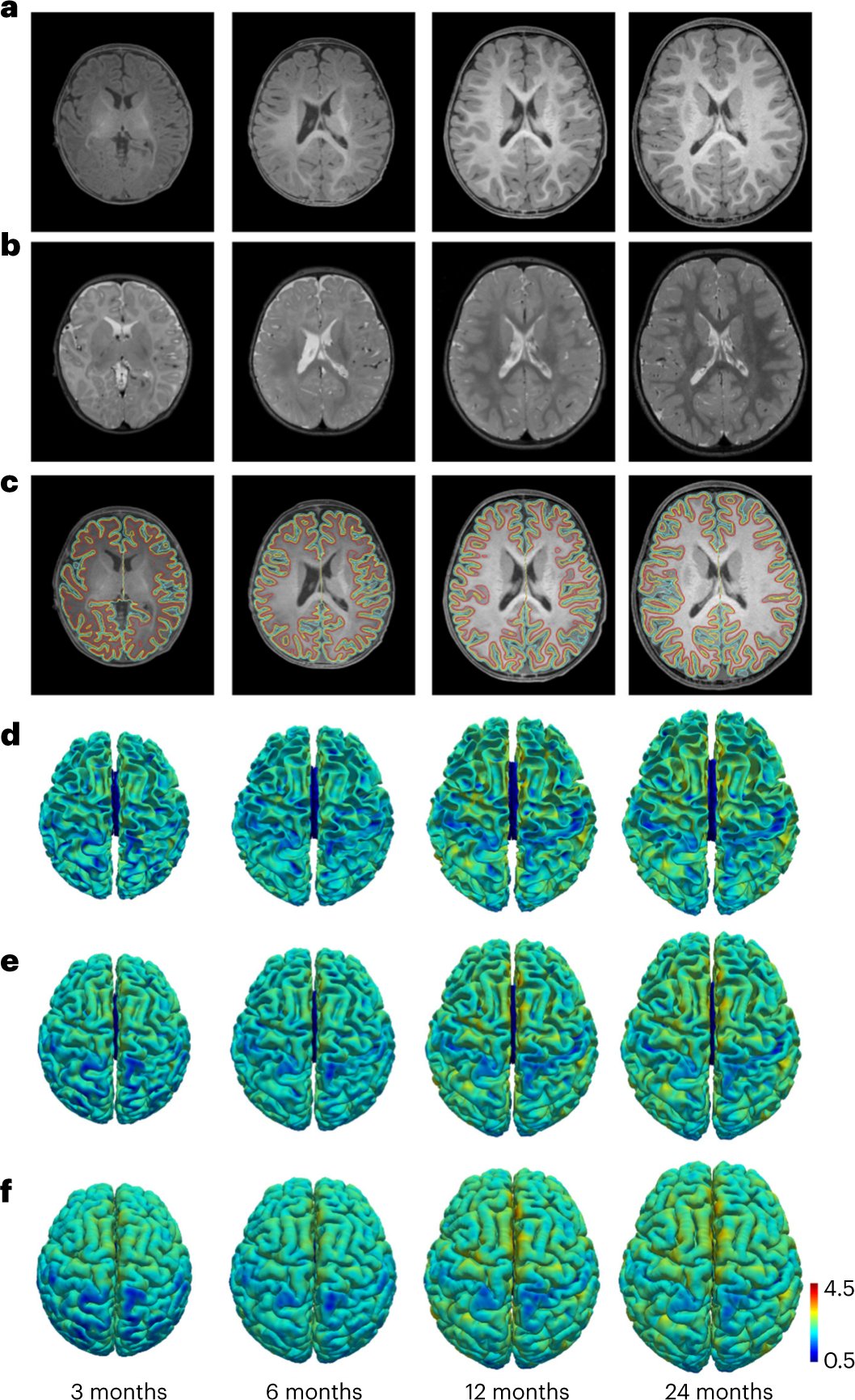 Fig. 4: The T1w images, T2w images and reconstructed cortical surfaces for the same subject at different ages.