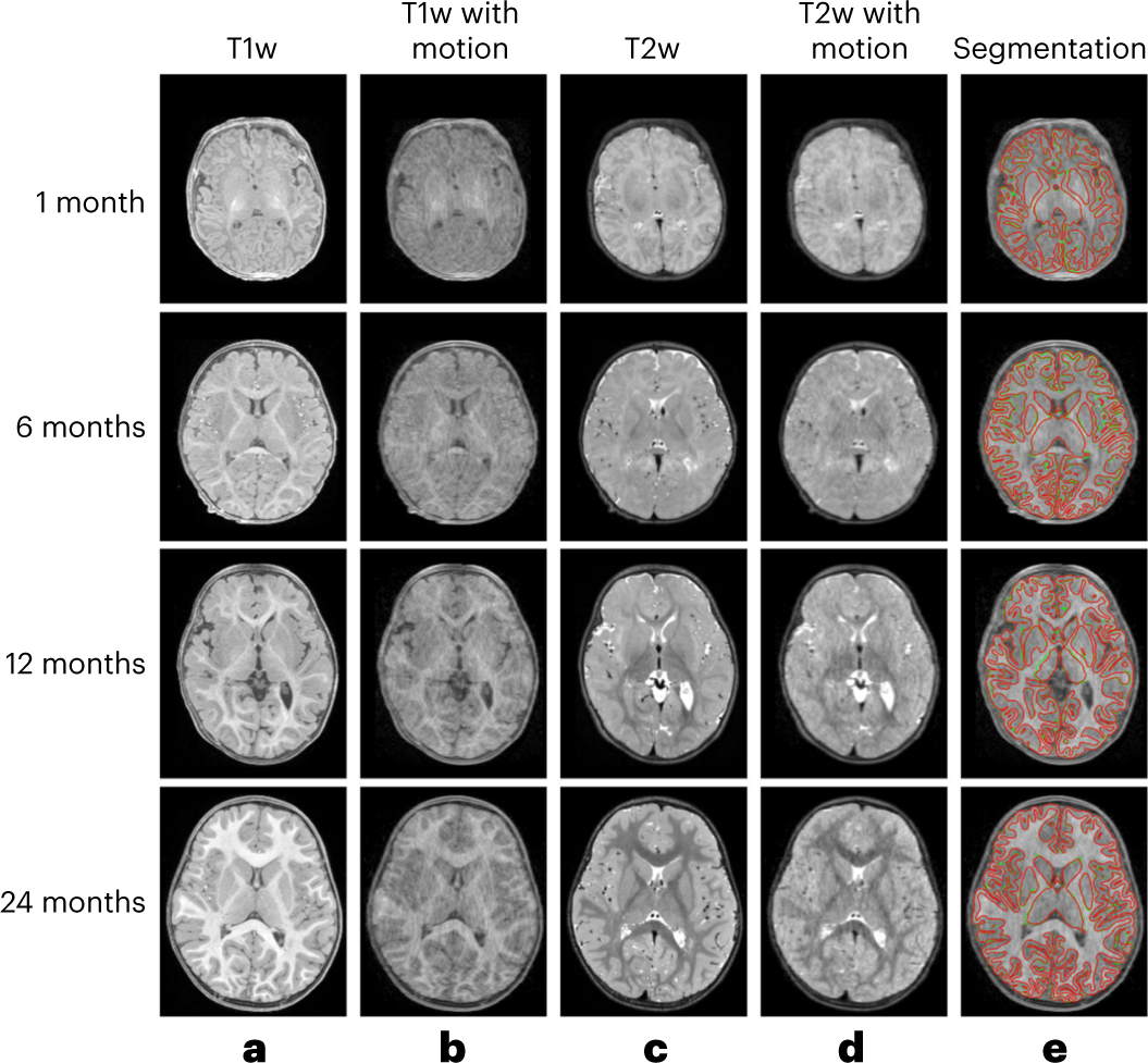 Fig. 7: The evaluation of the pipeline motion artifacts robustness on typical BCP subjects of different ages.