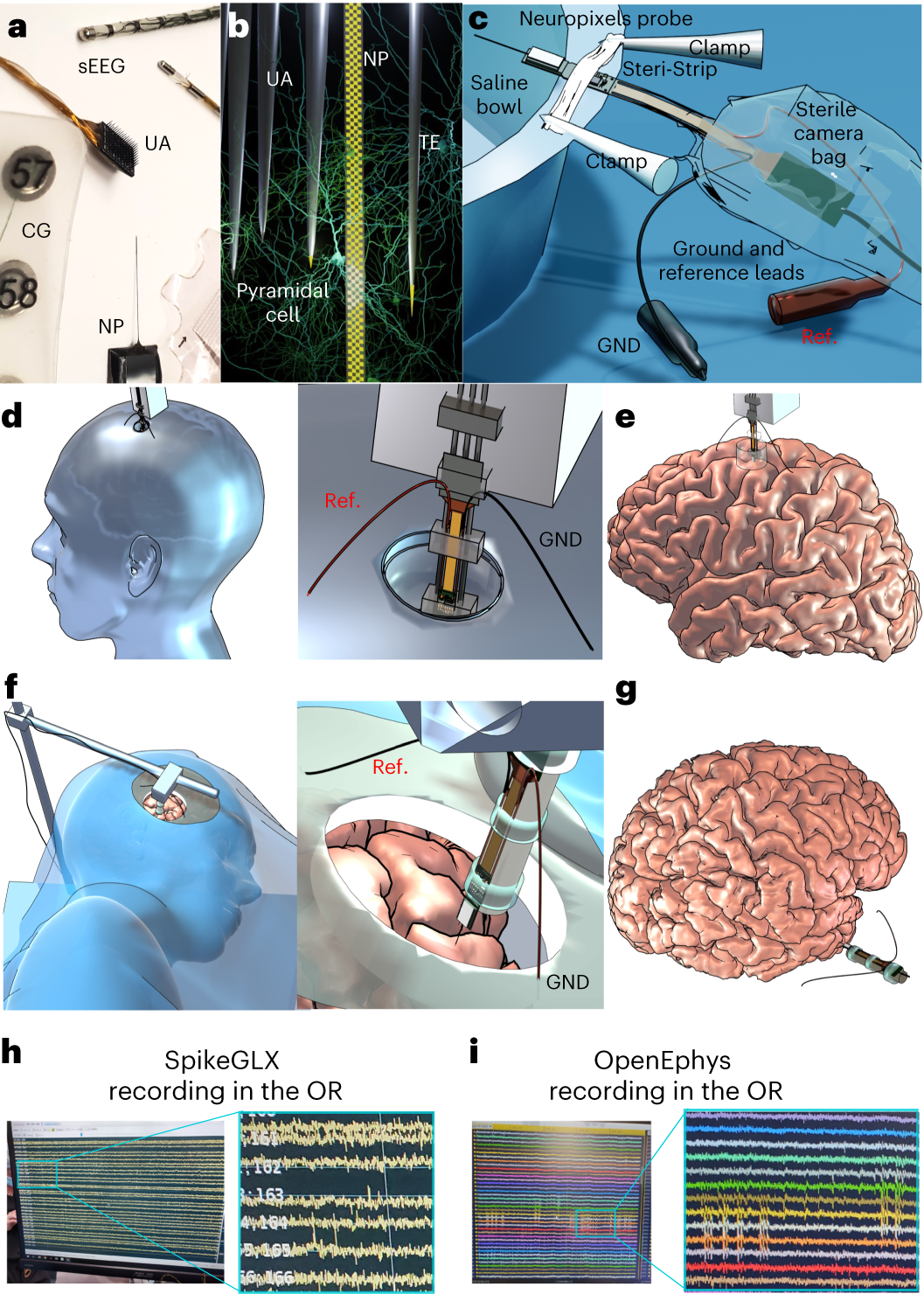 Fig. 1: Recording human brain activity with the Neuropixels probe in the operating room.