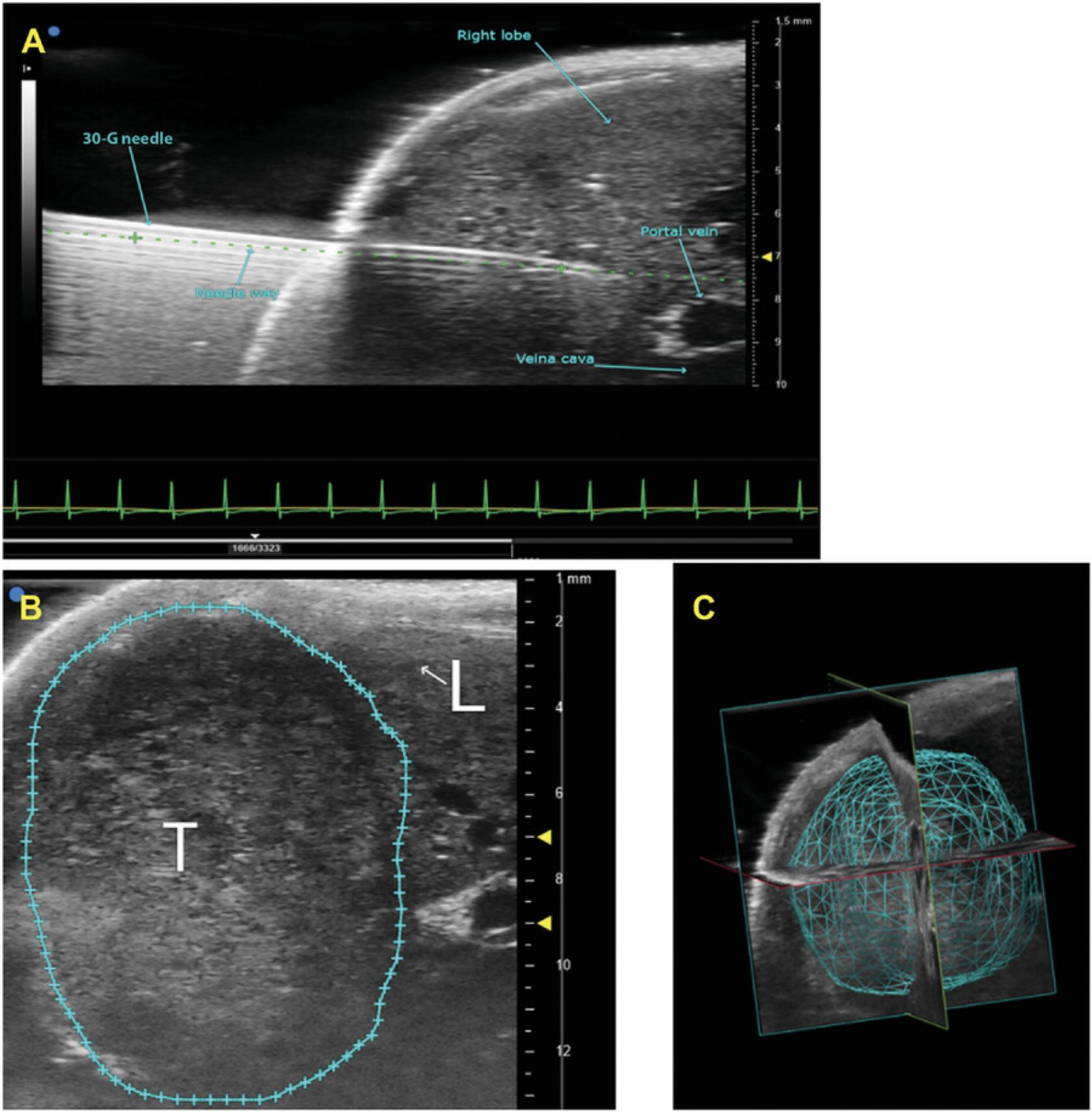 Details are in the caption following the image Representative ultrasound images of echo-guided injection and tumor. (A) Optimal position and alignment of the needle for injection of Huh-7-Luc tumor cells with 30-G needle buried within the right lobe of the liver. (B) Completed contour of tumor formation at 2 weeks after cells injection (2D area in blue). (C) Once contours have been drawn around the tumor in each slice, the software can reconstruct the tumor and quantify the volume.