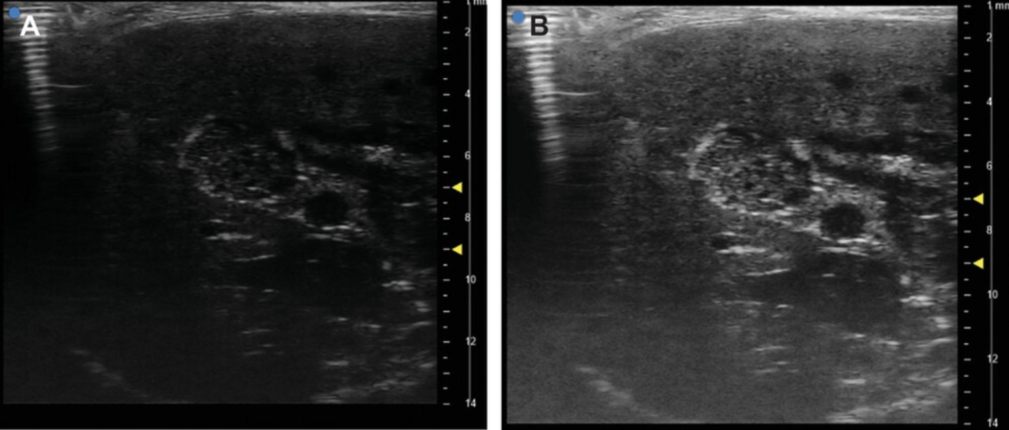 Details are in the caption following the image Suboptimal and optimal ultrasound imaging of tumor. (A) Suboptimal tumor imaging without adjustment of brightness and contrast. (B) Optimal imaging after modification to visualize the proper contrast between the tumor and the surrounding liver parenchyma.