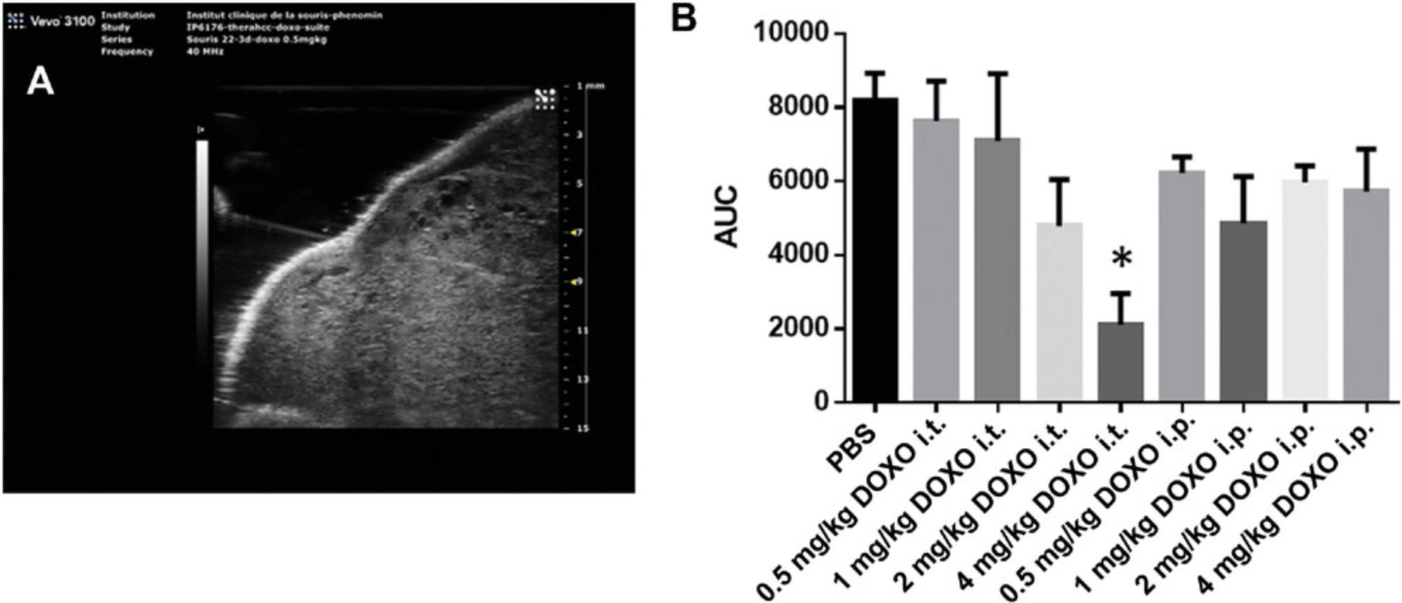 Details are in the caption following the image (A) Representative ultrasound image of echo-guided intratumoral (i.t.) injection of doxorubicin (DOXO). Optimal position and alignment of the needle before doxorubicin injection. (B) Area under the curve (AUC) calculated from the curves of tumor volume (n = 6 per condition) during follow-up after doxorubicin treatment delivered i.t. or intraperitoneally (i.p.). Data were compared to control mice treated with phosphate-buffered saline (PBS) using an ANOVA and Bonferroni test. *p < 0.05.