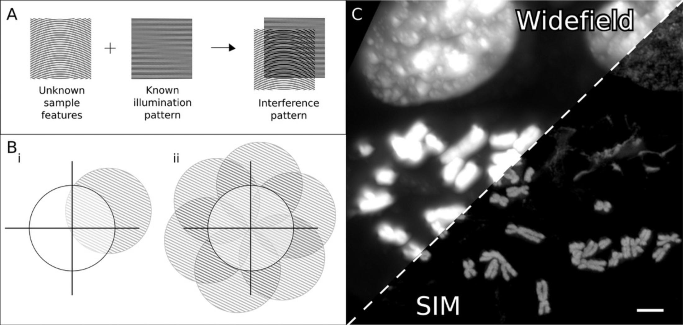 Details are in the caption following the image Structured illumination microscopy (SIM). (A) If unknown features in a sample are illuminated with a known regular illumination pattern, an interference pattern (moiré fringes) will appear. The unresolved structure of the sample can be deduced from the fringes. During image acquisition, the illumination pattern is both shifted and rotated. (B) (i) In Fourier space, a microscope's observable space is limited by the highest frequency information that can be transmitted by the objective (white circle). When the sample is illuminated with structured light, some higher frequencies (lined circle) are translated into the observable region. (ii) In order to produce isotropic improvement in lateral resolution, the structured illumination must be rotated and phase shifted and all of the resulting images combined for the reconstruction. (C) Comparison of chromosomes imaged by widefield microscopy versus SIM. Scale bar = 5 μm. Image acquired at the Octopus Facility at the Central Laser Facility by Chris Lynch with input from Stephen Webb, Mohamed Yusuf, Stan Botchway, and Ian Robinson.