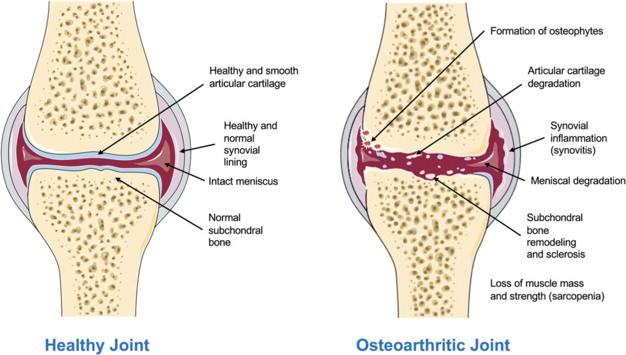 Details are in the caption following the image Schematic illustrating a healthy knee joint and an osteoarthritic knee joint. This figure was adapted using images from Servier Medical Art by Servier, licensed under a Creative Commons Attribution 3.0 Unported License (https://creativecommons.org/licenses/by/3.0/).