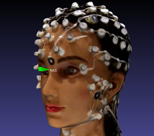 Green pin placed on Nasion (NAS). Green pin placed on Nasion (NAS).