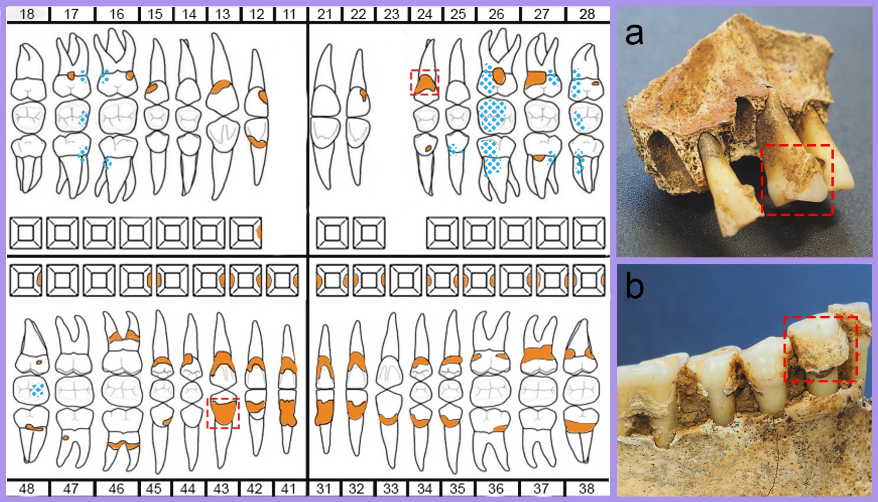 The figure shows an example of how you can document the DC sample. At your left is an example of an odontogram adapted for the MEDICAL project. The odontogram shows the DC position (in orange), dental pathologies (in blue), and the DC sampled (in red). Figure a and b show the DC before the sampling. The figure shows an example of how you can document the DC sample. At your left is an example of an odontogram adapted for the MEDICAL project. The odontogram shows the DC position (in orange), dental pathologies (in blue), and the DC sampled (in red). Figure a and b show the DC before the sampling.
