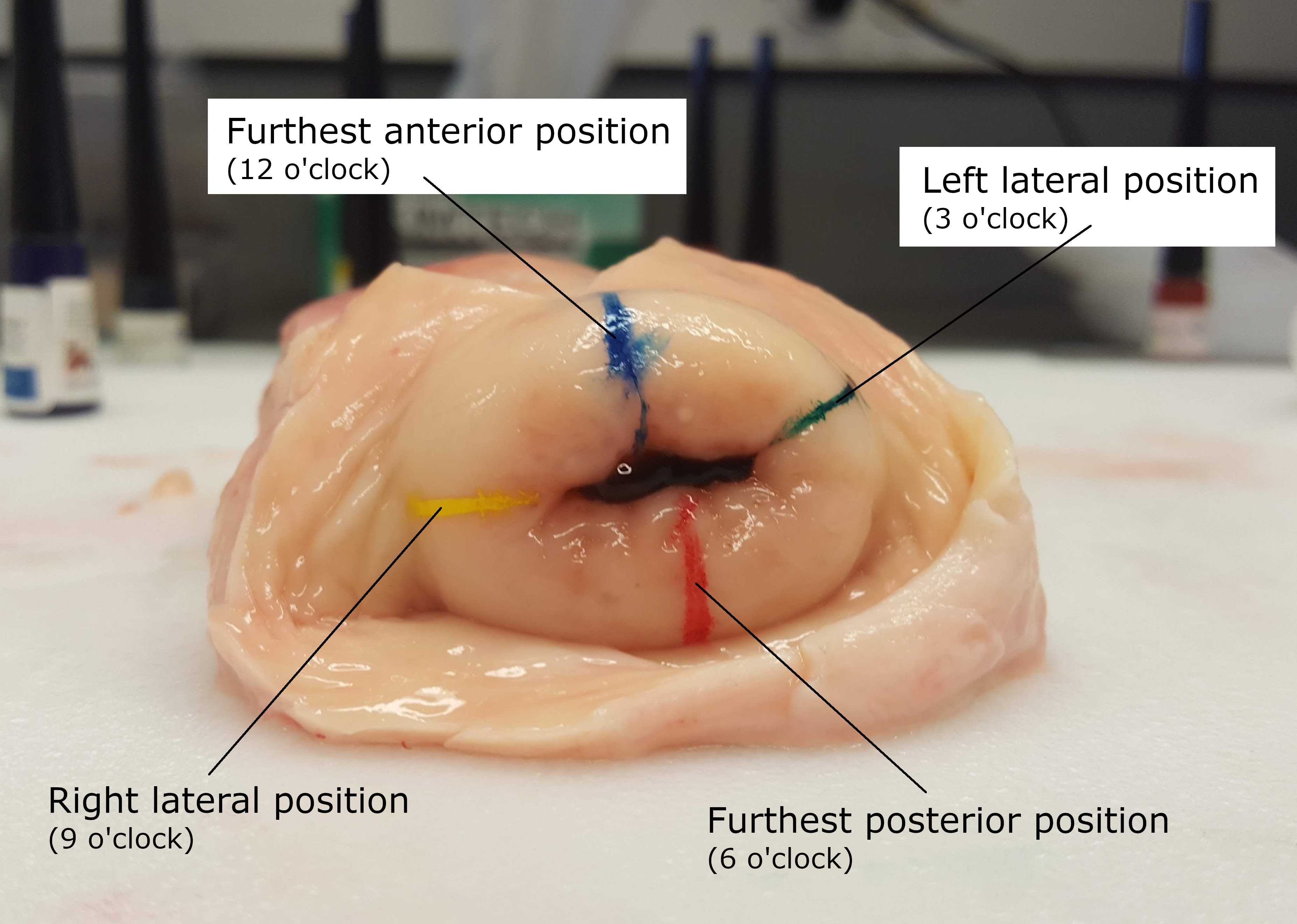 Orienting the Cervix for Dissection. The ectocervix is the portion of the uterus covered with squamous epithelium that extends into the vagina. The ectocervix can be seen inside the vagina during a gynecologic exam. The opening in the center of the ectocervix is the external os. The external cervical os is the opening to the endocervix, a tunnel through the cervix lined with glandular cells that leads to the uterine cavity. Knowing position of tissue sample with respect to it’s clock-like position in the cervix will assist with registering the wedge on 3D representations of the organ as is done on HuBMAP’s registration user interface (RUI). Orienting the Cervix for Dissection. The ectocervix is the portion of the uterus covered with squamous epithelium that extends into the vagina. The ectocervix can be seen inside the vagina during a gynecologic exam. The opening in the center of the ectocervix is the external os. The external cervical os is the opening to the endocervix, a tunnel through the cervix lined with glandular cells that leads to the uterine cavity. Knowing position of tissue sample with respect to it’s clock-like position in the cervix will assist with registering the wedge on 3D representations of the organ as is done on HuBMAP’s registration user interface (RUI).