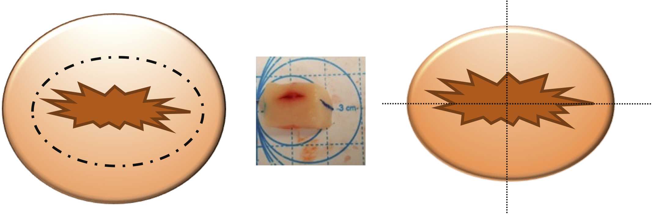 Orienting the Endocervix for Dissection. The endocervical canal is tunnel lined with glandular cells surrounded by fibrous muscular tissue that connects the vagina and uterine cavity. Excess fibromuscular tissue is removed to ensure signal from the endocervical canal is not obscured by the abundant stromal tissue. Orienting the Endocervix for Dissection. The endocervical canal is tunnel lined with glandular cells surrounded by fibrous muscular tissue that connects the vagina and uterine cavity. Excess fibromuscular tissue is removed to ensure signal from the endocervical canal is not obscured by the abundant stromal tissue.