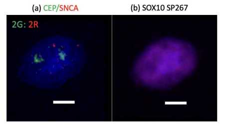 Figure 3. Examples showing (a) Chr 7 CEP and SNCA FISH signals and (b) a SOX10+ nucleus. Figure 3. Examples showing (a) Chr 7 CEP and SNCA FISH signals and (b) a SOX10+ nucleus.