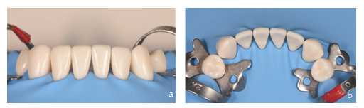 Figure 3. Absolute isolation with Nic tone rubber dam (MDC Dental. Jalisco. Mexico), frontal (a) and occlusal view (b). Figure 3. Absolute isolation with Nic tone rubber dam (MDC Dental. Jalisco. Mexico), frontal (a) and occlusal view (b).