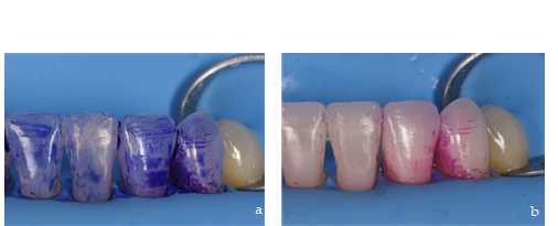 Figure 4. Revealing bacterial plaque (Bioclear dual color disclosing. Bioclear) (a,b). Figure 4. Revealing bacterial plaque (Bioclear dual color disclosing. Bioclear) (a,b).