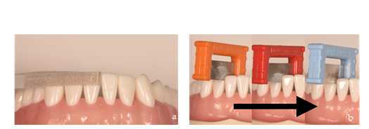 Figure 2. Contact point relief with Sof-Lex strips (a) (3M ESPE.St.Paul. MN. USA) or “tru-contact” manual sanding (b) (Bioclear). Figure 2. Contact point relief with Sof-Lex strips (a) (3M ESPE.St.Paul. MN. USA) or “tru-contact” manual sanding (b) (Bioclear).