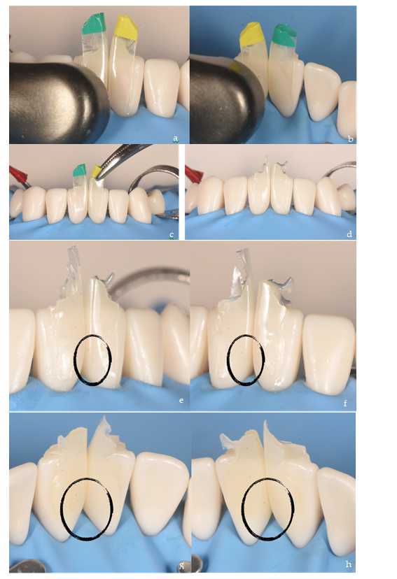 Figure 9. Polymerization of the composite, 20s for each surface and removal of matrices (a, b). Detail of matrix removal with mosquito forceps, previously it is necessary to open it a little to eliminate the vacuum effect (c). The restorations just after removing the matrices are a perfect model of them (d). Vestibular (e, f) and palatal (g, h) details of the restorations before finishing. Figure 9. Polymerization of the composite, 20s for each surface and removal of matrices (a, b). Detail of matrix removal with mosquito forceps, previously it is necessary to open it a little to eliminate the vacuum effect (c). The restorations just after removing the matrices are a perfect model of them (d). Vestibular (e, f) and palatal (g, h) details of the restorations before finishing.