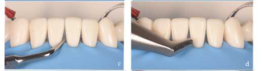 Figure 4. Removal of bacterial plaque with dental ultrasonic device (c) (universal tip no. 1. Acteon Satelec. Aquitaine. France) and/or bicarbonate spray (d) (Air-n-go easy. Acteon Satelec). Figure 4. Removal of bacterial plaque with dental ultrasonic device (c) (universal tip no. 1. Acteon Satelec. Aquitaine. France) and/or bicarbonate spray (d) (Air-n-go easy. Acteon Satelec).