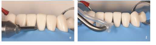 Figure 4. Conditioning of the substrate with dry aluminum oxide (e) (Dento-Prep. Ronvig. Copenhagen. Denmark) or mixed with water (f) (Aquacare. Velopex. London. UK). Figure 4. Conditioning of the substrate with dry aluminum oxide (e) (Dento-Prep. Ronvig. Copenhagen. Denmark) or mixed with water (f) (Aquacare. Velopex. London. UK).