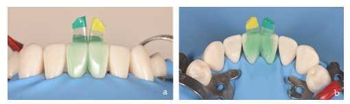 Figure 6. Simultaneous conditioning of both teeth with orthophosphoric acid (a,b) (37%. Proclinic. Barcelona. Spain). Figure 6. Simultaneous conditioning of both teeth with orthophosphoric acid (a,b) (37%. Proclinic. Barcelona. Spain).