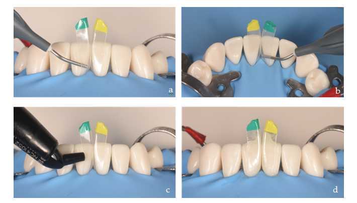 Figure 8. Application of composite, in the top photos the detail of the tip of the syringe of the flowable composite can be seen (Filtek Supreme XTE A1 flow. 3M ESPE.) placed at the base of the vestibular and lingual black triangle (8a,8b). In the bottom photos a detail of the opening of a matrix with the tip of the compul (8c) (Filtek Supreme XTE. A1B. 3M ESPE.) and in the last picture the composite mix applied and the excess overflowing incisal (8d). Figure 8. Application of composite, in the top photos the detail of the tip of the syringe of the flowable composite can be seen (Filtek Supreme XTE A1 flow. 3M ESPE.) placed at the base of the vestibular and lingual black triangle (8a,8b). In the bottom photos a detail of the opening of a matrix with the tip of the compul (8c) (Filtek Supreme XTE. A1B. 3M ESPE.) and in the last picture the composite mix applied and the excess overflowing incisal (8d).