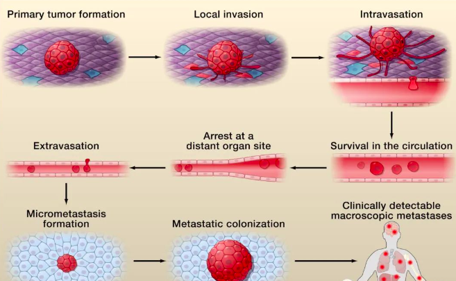 Figure 1: The Process of Tumor Cell Metastasis in the Body Figure 1: The Process of Tumor Cell Metastasis in the Body