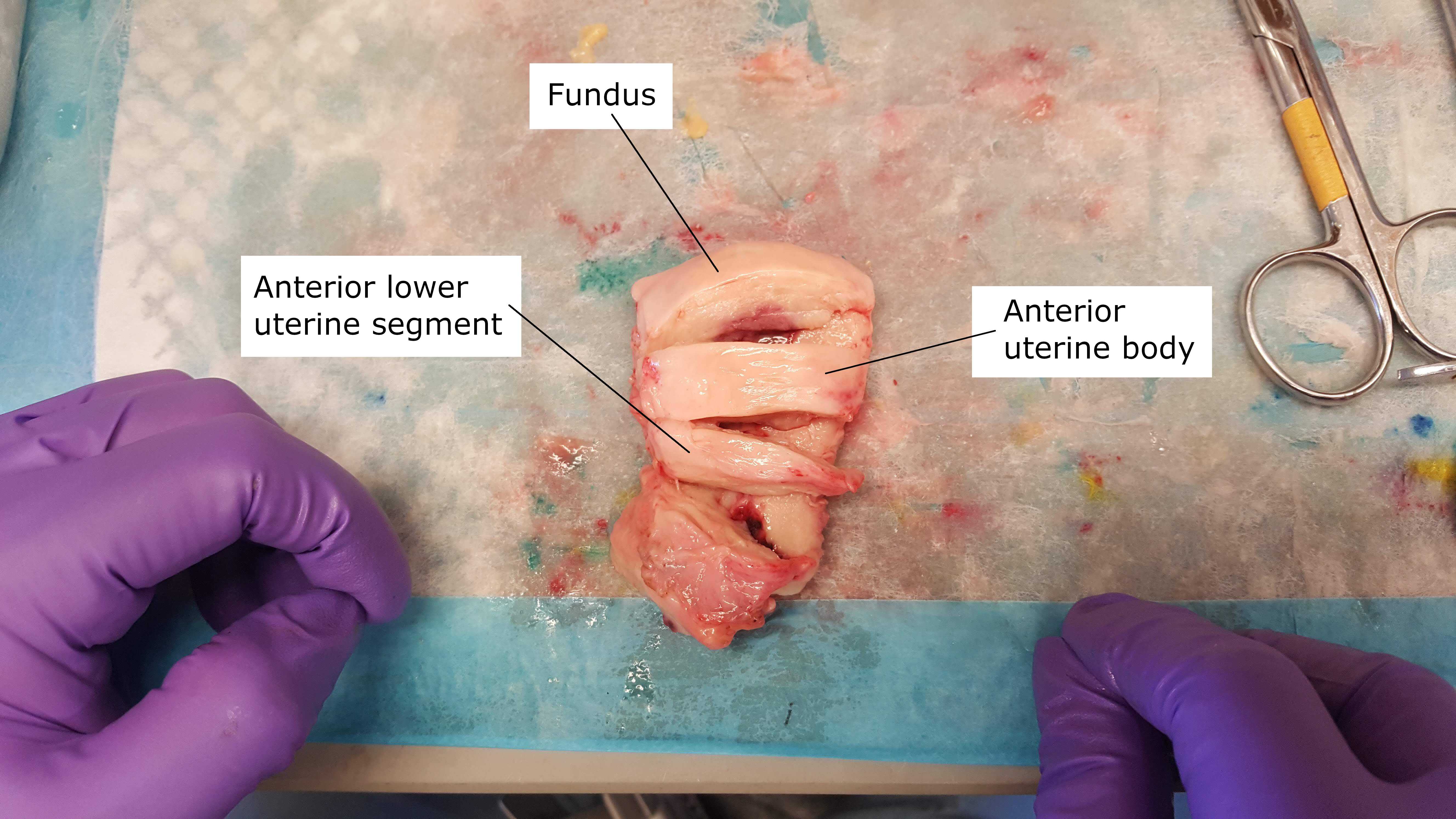 Dissection of the Uterine Body. First the coronal plane of the uterus is used to divide the anterior and posterior walls of the uterus. The uterus is then divided into the fundus, uterine body and lower uterine segment (LUS). The LUS is the area of the uterus that undergoes circumferential dilatation during labor. Its inferior anatomic border is the junction of the cervix and uterus (internal cervical os). Here the vesicouterine reflection was used as the superior anatomic border of the LUS. The fundus is the round area at the top of the uterus above the openings of the Fallopian tubes. The remaining area about the LUS and below the fundus is the uterine body. Dissection of the Uterine Body. First the coronal plane of the uterus is used to divide the anterior and posterior walls of the uterus. The uterus is then divided into the fundus, uterine body and lower uterine segment (LUS). The LUS is the area of the uterus that undergoes circumferential dilatation during labor. Its inferior anatomic border is the junction of the cervix and uterus (internal cervical os). Here the vesicouterine reflection was used as the superior anatomic border of the LUS. The fundus is the round area at the top of the uterus above the openings of the Fallopian tubes. The remaining area about the LUS and below the fundus is the uterine body.