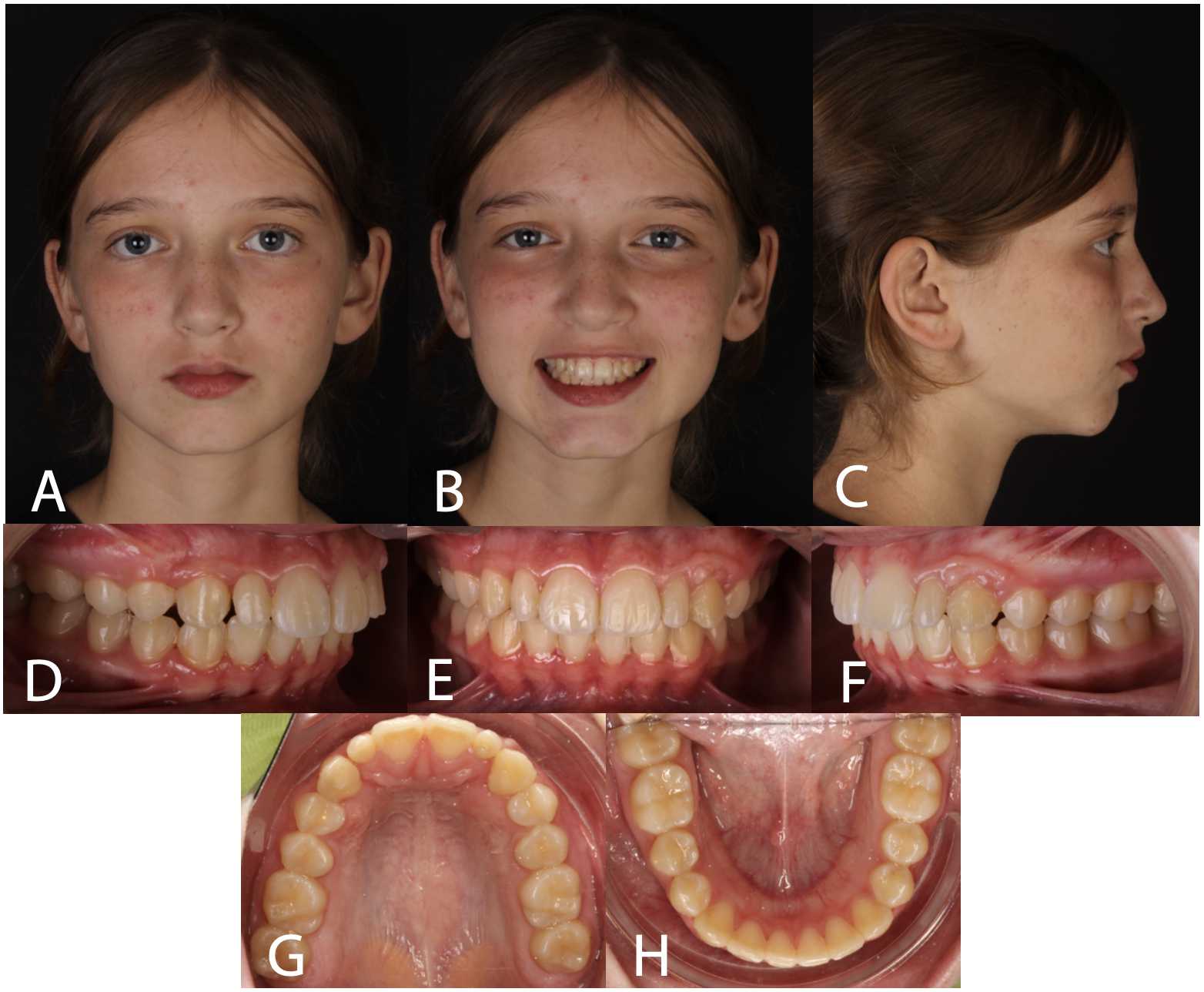Figure 1 – (A-C) Examples of facial photographs taken with the patient’s head in its natural position. (D-H) Intraoral photo series. Figure 1 – (A-C) Examples of facial photographs taken with the patient’s head in its natural position. (D-H) Intraoral photo series.