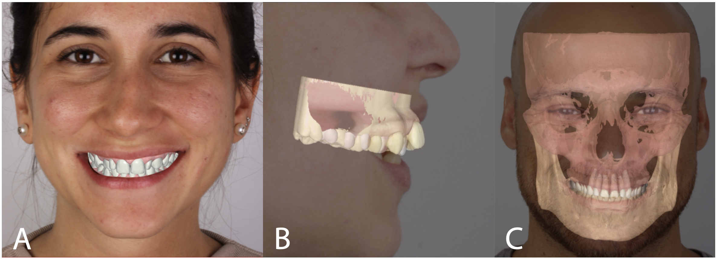 Figure 2 – (A, B) STL digital scans orientated, aligned and superimposed onto natural head position photographs. (C) A CBCT DICOM file and an STL digital scan superimposed onto a frontal natural head position photograph. Figure 2 – (A, B) STL digital scans orientated, aligned and superimposed onto natural head position photographs. (C) A CBCT DICOM file and an STL digital scan superimposed onto a frontal natural head position photograph.