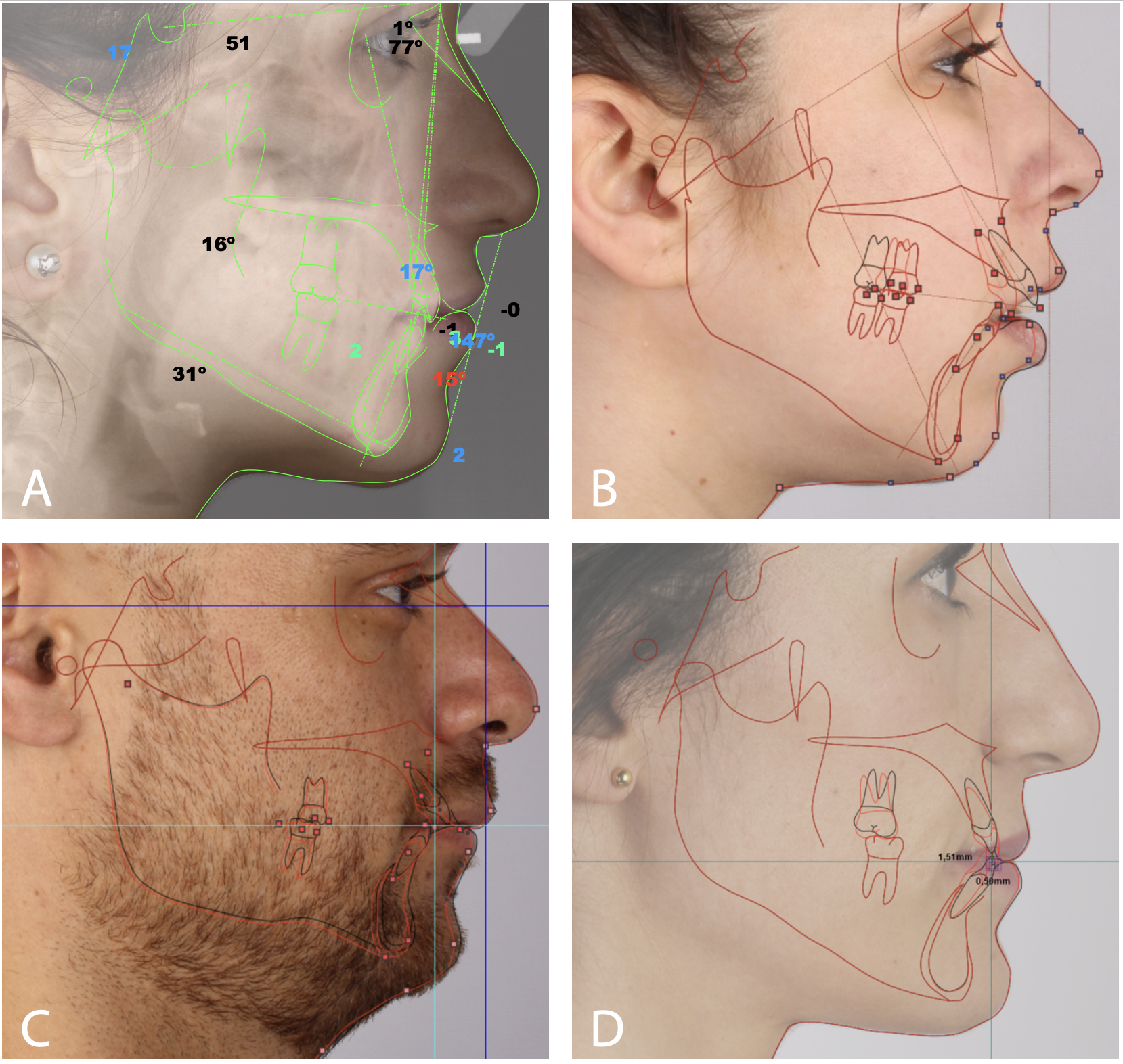 Figure 4 – VTO analysis of a class I patient (A), class II patients (B,C) and a class III patient (D), showing the versatility of the protocol. Figure 4 – VTO analysis of a class I patient (A), class II patients (B,C) and a class III patient (D), showing the versatility of the protocol.