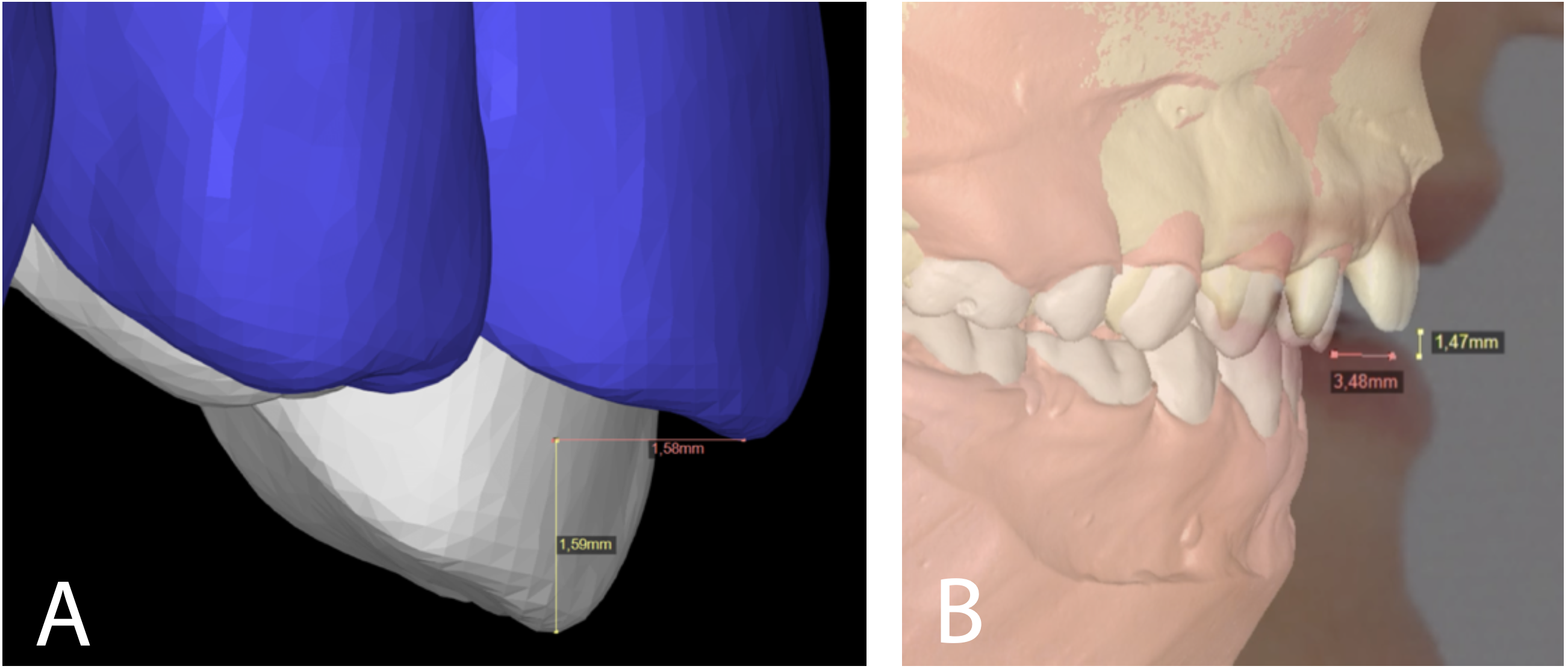 Figure 5 – (A,B) Determination and quantification of the desired movement of the upper central incisor. Figure 5 – (A,B) Determination and quantification of the desired movement of the upper central incisor.